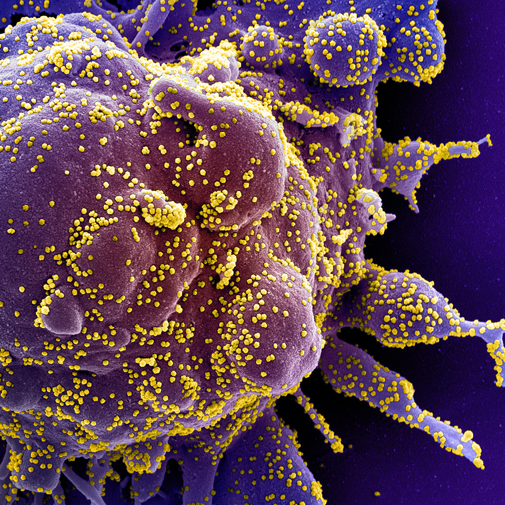 Colorized scanning electron micrograph of an apoptotic cell heavily infected with SARS-COV-2 virus particles 