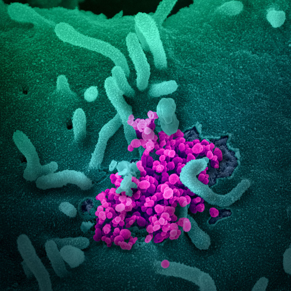 A scanning electron microscope image of SARS-CoV-2 emerging from the surface of human cells